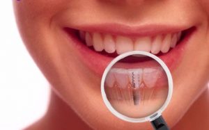 dentista roma impianto denti